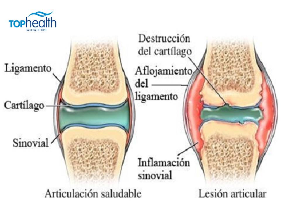 Artrosis de Rodilla - Fisiosite BlogFisiosite Blog